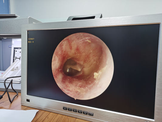 22 Inch Monitor Integrated ENT Full HD Endoscope Camera System Set Portable